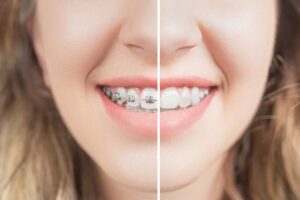 Metal Braces